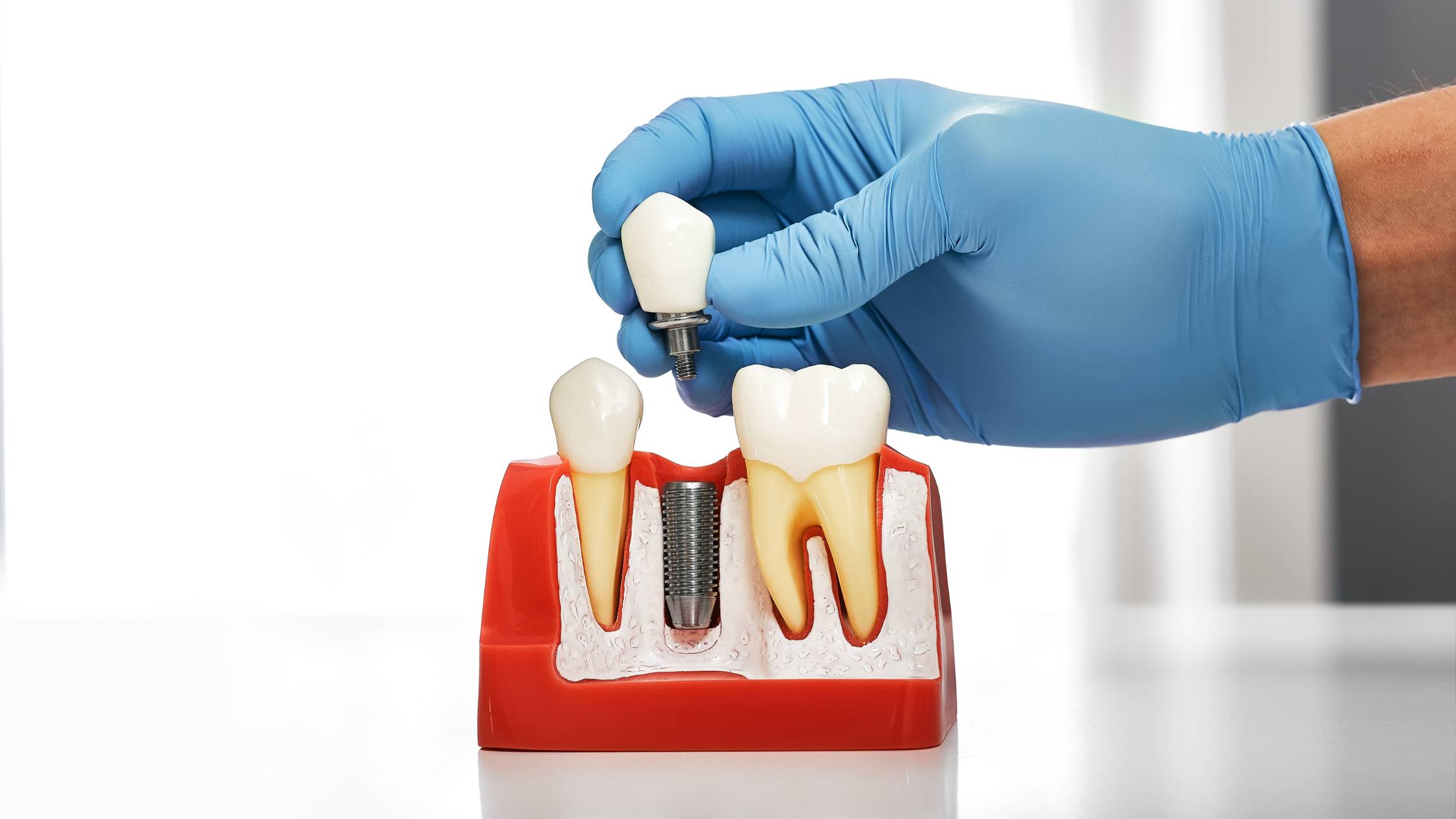 sostituzione dente