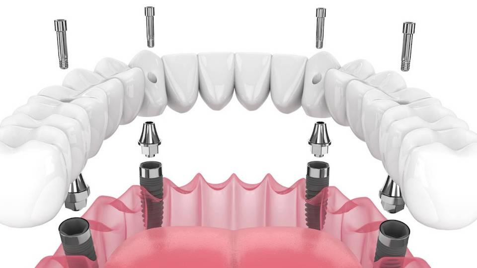 Metodo All-on-4: la soluzione per la perdita totale dei denti