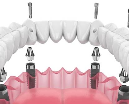 Metodo All-on-4: la soluzione per la perdita totale dei denti