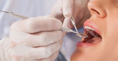 Come il bruxismo influisce sui tuoi denti – e come trattarlo