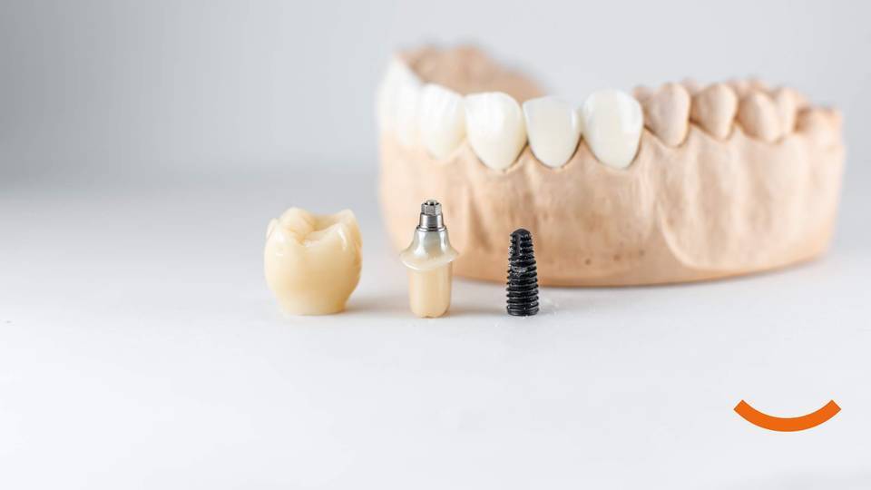 Vivere con gli impianti dentali: Manutenzione e cura