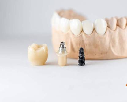 Vivere con gli impianti dentali: Manutenzione e cura