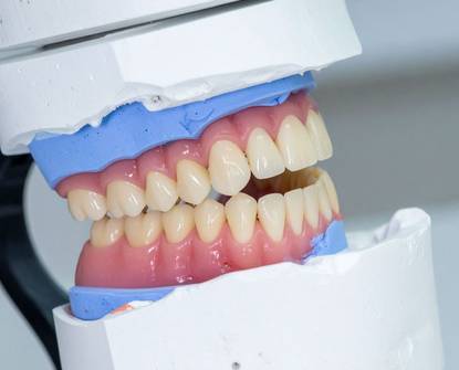 Impianti All-on-4: vantaggi e procedura