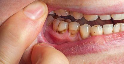 Placca e tartaro dentale: perché si formano e come rimuoverli