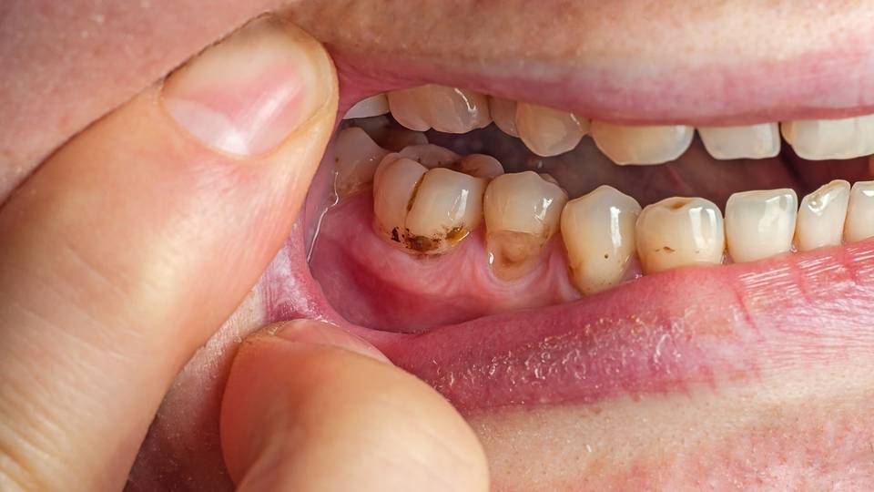 Placca e tartaro dentale: perché si formano e come rimuoverli