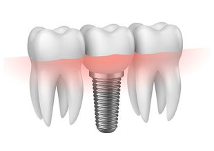 ti manca un dente?