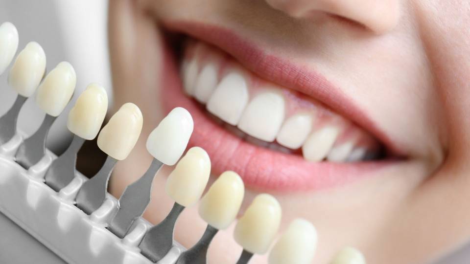 Sbiancamento dei denti a casa vs. professionale: vantaggi e svantaggi