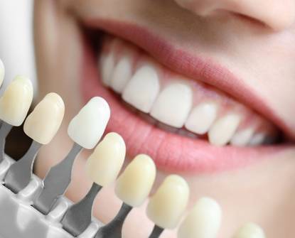 Sbiancamento dei denti a casa vs. professionale: vantaggi e svantaggi