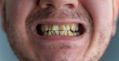 Trasformazione del sorriso: makeover completo passo dopo passo con Dentico