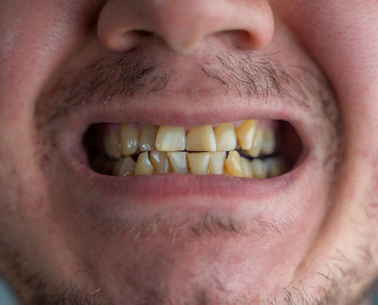 Trasformazione del sorriso: makeover completo passo dopo passo con Dentico