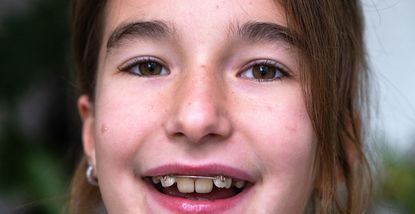Opzioni ortodontiche per bambini e adolescenti: quando è il momento giusto per l’apparecchio?