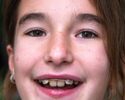 Opzioni ortodontiche per bambini e adolescenti: quando è il momento giusto per l’apparecchio?