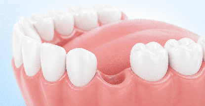 Cosa succede quando non si sostituisce un dente mancante?