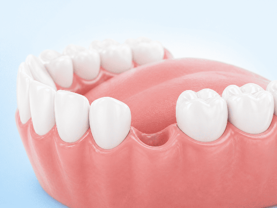 Cosa succede quando non si sostituisce un dente mancante?