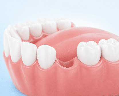 Cosa succede quando non si sostituisce un dente mancante?