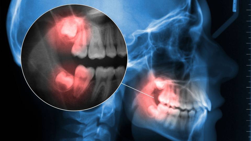 Tutto ciò che dovete sapere sull’estrazione dei denti del giudizio