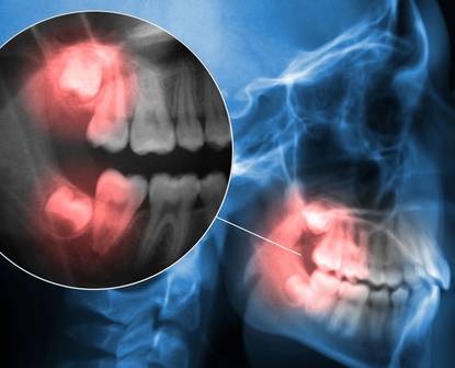 Tutto ciò che dovete sapere sull’estrazione dei denti del giudizio