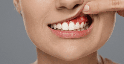Come riconoscere e curare l'infiammazione delle gengive: Sintomi e trattamenti