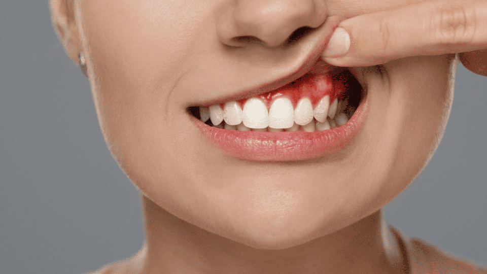 Come riconoscere e curare l'infiammazione delle gengive: Sintomi e trattamenti