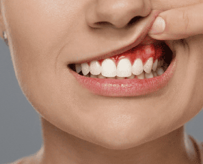 Come riconoscere e curare l'infiammazione delle gengive: Sintomi e trattamenti