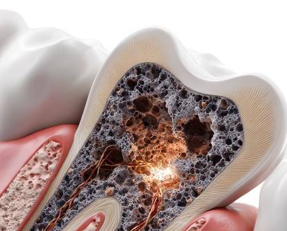 Erosione dentale: come gli acidi influiscono sui denti e come proteggersi