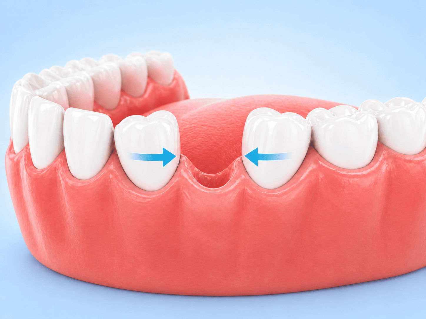 spostamento dei denti verso lo spazio vuoto